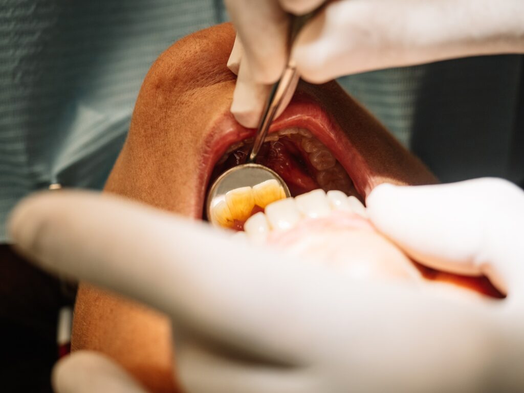Patient receiving a deep dental cleaning at Crouch Family Dentistry in Statesville NC